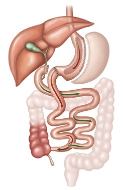 Laparoscopic Bilio-Pancreatic Diversion with Duodenal Switch (BPD/DS)