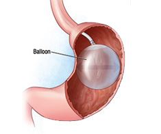 Endoscopic Intragastric Balloon