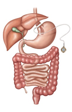 Laparoscopic Adjustable Gastric Band (LAGB)