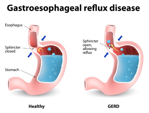 Gastroesophageal Reflus Disease