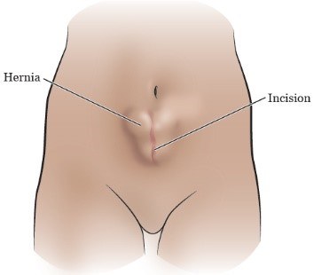 Herniation in the incision site