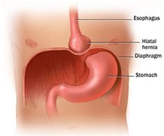 Hiatus Hernia