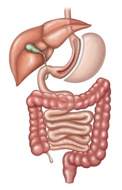 Laparoscopic Sleeve Gastrectomy (LSG)