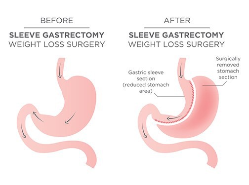 Laparoscopic Sleeve Gastrectomy (LSG)