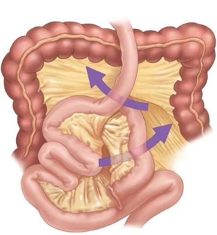 Mesenteric defects & small bowel obstruction