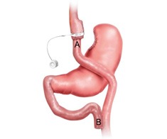 Mesenteric defects & small bowel obstruction